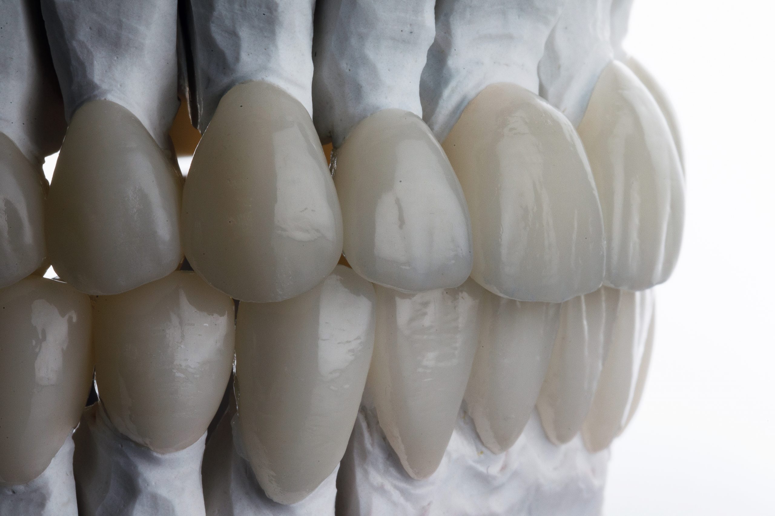 Beautiful,Ceramic,Teeth,Made,In,The,Dentist,'s,Office,On